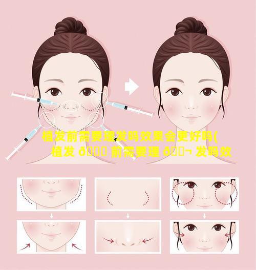 植发前需要理发吗效果会更好吗(植发 🐛 前需要理 🐬 发吗效果会更好吗女生)